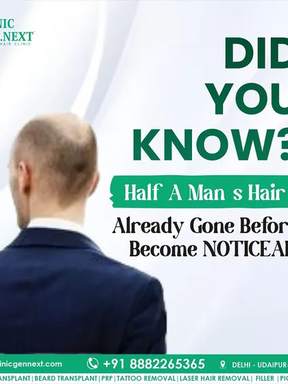 Did you know? A man often loses half of his hair before the baldness becomes noticeable to others. This is why early consultation is so important.