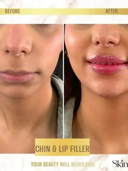A before and after view demonstrating the power of combining chin and lip fillers. We enhanced the lip volume for a fuller pout and strengthened the chin to create a more balanced and defined side profile.