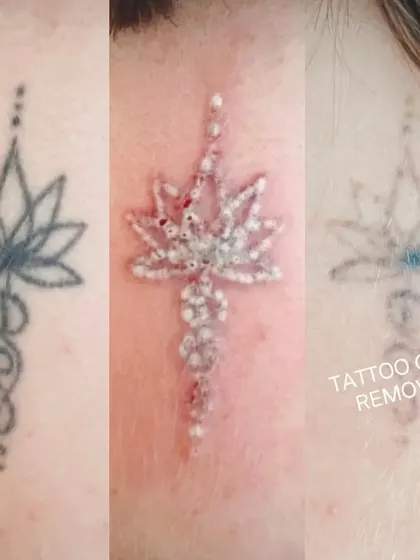 This image shows the complete tattoo removal journey for a lotus design. You can see the original tattoo, the 'frosting' effect immediately after a laser session which is normal, and the final faded result after healing.