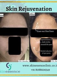 Advanced Laser Treatments