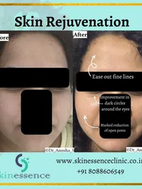 Advanced Laser Treatments