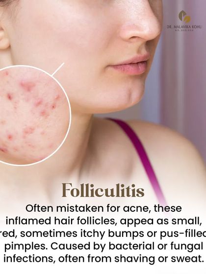 Folliculitis is an inflammation of the hair follicles, often mistaken for acne. It presents as small, red, sometimes itchy bumps or pus-filled pimples, typically caused by bacterial or fungal infections related to shaving or sweat.