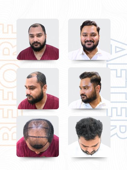 This multi-angle view shows Abhijeet's complete journey. From the initial consultation to the final result, you can see how 4,357 grafts transformed his appearance, giving him a full and natural head of hair.