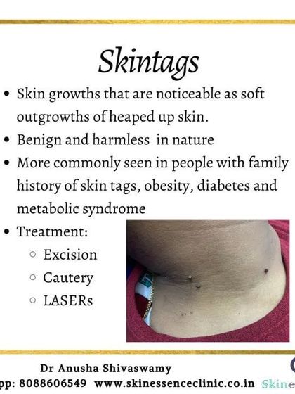 Anusha Shivaswamy - Minor Skin Surgery (Dermatosurgery) Safe Removal of Skin Tags & DPNs photo 5