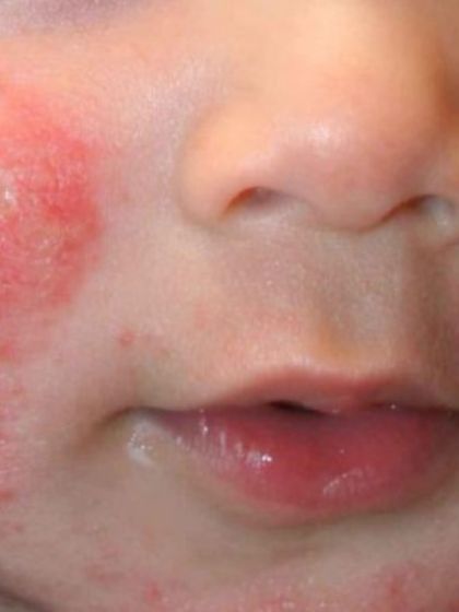 Severe facial eczema in a baby can be very distressing for both the child and parents. I focus on gentle treatments that repair the skin's barrier, reduce itching, and bring comfort back to your little one.