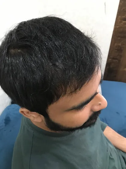 A great example of a final hair transplant result. The hair is dense, healthy, and can be styled naturally, completely reversing the signs of hair loss and restoring the client's original look.