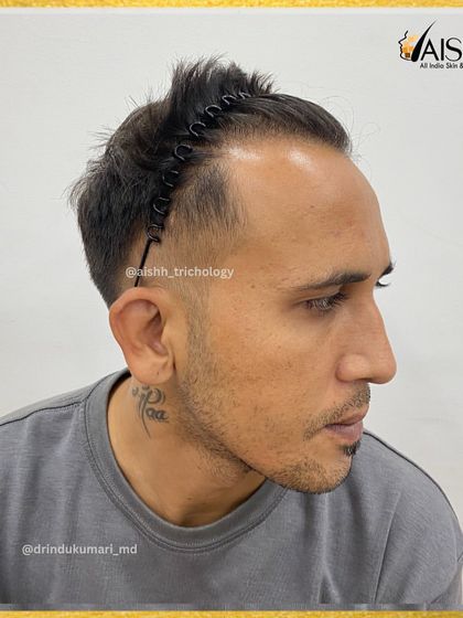 This patient presented with Grade 3-4 baldness. This 'before' image shows the extent of his hair loss from the side.