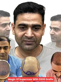 Hair Transplant