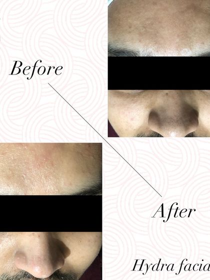This before and after of a male client shows how a HydraFacial infuses the skin with hydrating serums, leaving it refreshed and clear.
