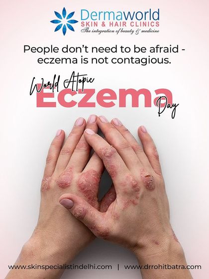 On World Atopic Eczema Day, it is important to remember that eczema is not contagious. It is a common skin condition that requires understanding and support, not fear or judgment.
