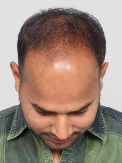 From Grade 5A baldness to bold confidence in just 7 months. This patient received 5850 grafts for a dense, natural-looking hairline.