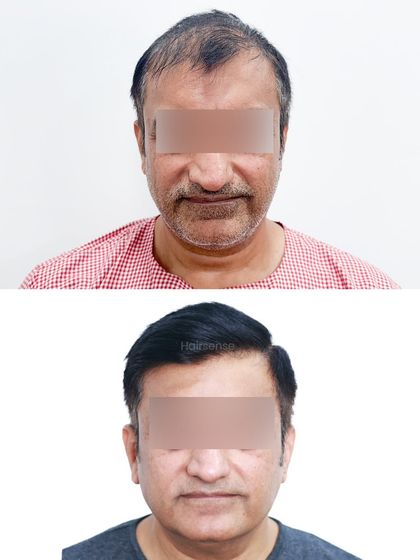 This front-view comparison shows how a well-executed hair transplant can make a person look several years younger.