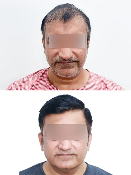 This front-view comparison shows how a well-executed hair transplant can make a person look several years younger.