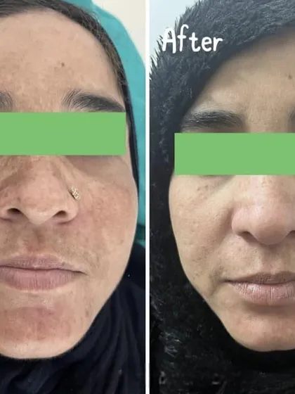 This client's skin pigmentation was significantly reduced through a combination of in-clinic treatments and prescribed oral medication. Our integrated approach ensures comprehensive and lasting results for complex skin concerns.