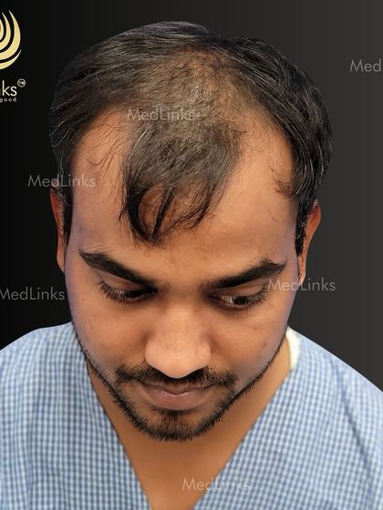 The view from the top shows the extent of thinning before the hair restoration procedure. Our planning ensures that we address these areas for a full and natural-looking outcome.