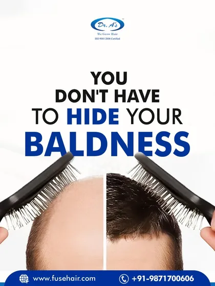 You don't have to hide your baldness. I can help you restore your natural hairline with an advanced, permanent hair transplant.