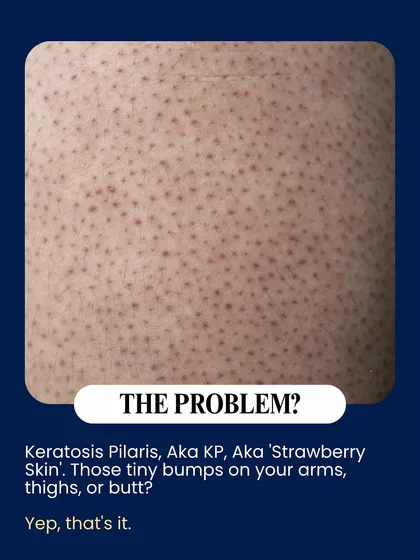 This image shows a close-up of Keratosis Pilaris, also known as 'strawberry skin'. These tiny bumps on the arms, thighs, or buttocks are a common concern, and I offer treatments to help smooth the skin's texture.