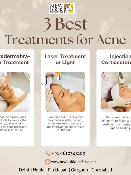 For those dealing with active acne, we have several effective strategies. This guide introduces three of our primary treatments: Microdermabrasion for exfoliation, Laser and Light Therapy to reduce bacteria and inflammation, and Corticosteroid Injections for targeting severe, inflamed cysts.