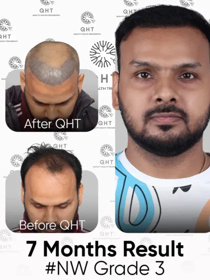 A 7-month result for a Norwood Grade 3 patient. The transformation from baldness to boldness is clear to see.