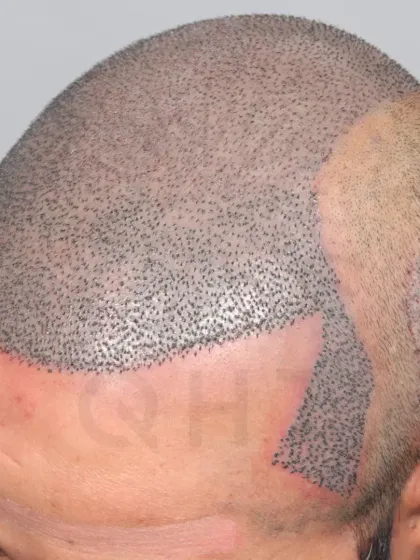 A high-grade baldness case just after surgery. 5700 grafts were used to recreate the hairline, frontal region, mid-scalp, crown, and temples.