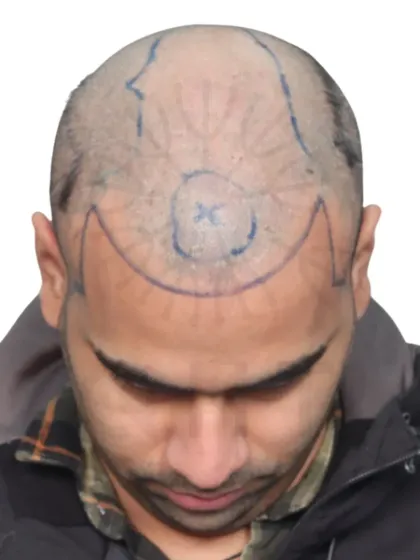 This shows the crucial first step: hairline design. We mark the area precisely to ensure the final result perfectly frames the face.