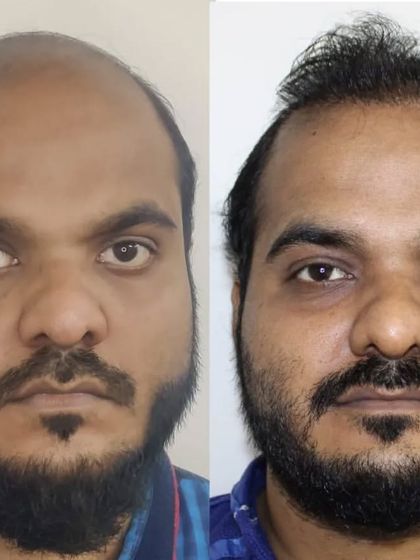 This patient came to me with advanced male pattern baldness. The 'after' photo shows a significant improvement in coverage and a newly defined hairline.