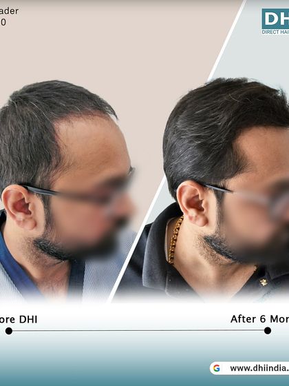 Another side-profile view of the 6-month transformation. The natural angle and direction of the implanted hair are evident, showcasing the precision of the DHI technique.