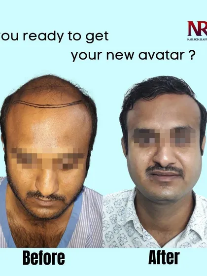 A duplicate of Image 1, this shows a client's complete transformation from advanced male pattern baldness to a full head of hair, showcasing his new avatar.