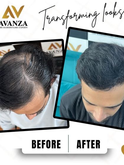 A remarkable change from significant thinning across the mid-scalp and crown to a full and dense head of hair. This is what we mean by reclaiming your crown.