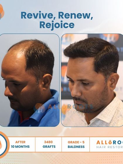 Revive, Renew, Rejoice. This 10-month result for a Grade 5 baldness case, using 3480 grafts, shows a complete restoration. The images from all angles prove that a full head of hair is an achievable goal.
