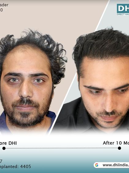 A before and after of a 27-year-old client 10 months post-procedure. With 4,405 hairs implanted, his hair is now dense, stylish, and completely natural-looking, reflecting the high satisfaction rate of our clients.