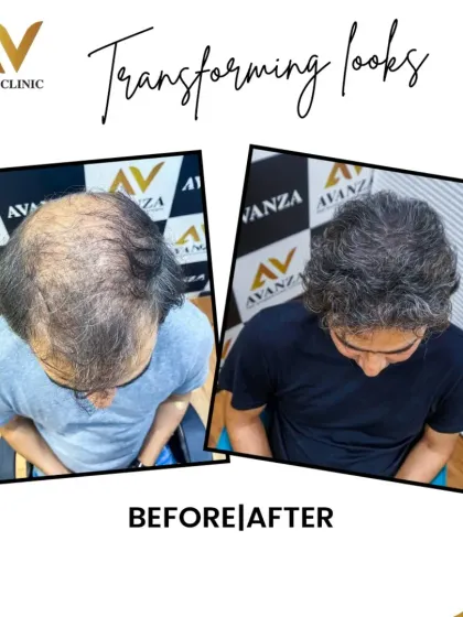 From significant thinning across the entire scalp to a full head of thick, healthy hair. This transformation showcases the power of our 'Hairodynamic' technique to achieve maximum density.