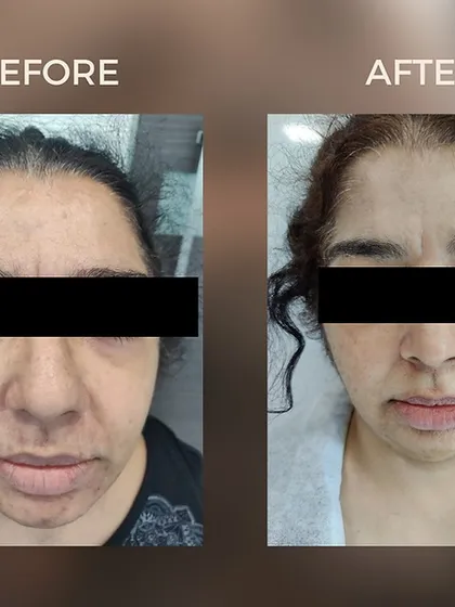 This before and after image showcases the results of our Carbon Tribeam laser treatment. We effectively addressed concerns of uneven skin tone, texture, and pigmentation, resulting in a visibly clearer, smoother, and more radiant complexion for our client.