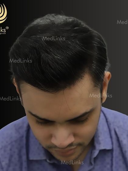 The top-down view after the transplant, showcasing the full coverage achieved.