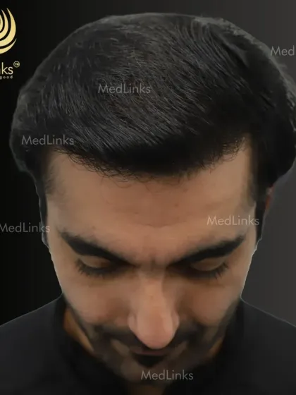 The final result from a top-down perspective. The new hair growth provides excellent coverage, and the hair texture and direction blend seamlessly with the surrounding hair.