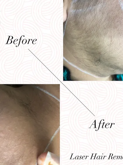 Say goodbye to unwanted facial hair. This before and after comparison demonstrates the significant reduction of hair on the side of the face, resulting in clearer and smoother skin.