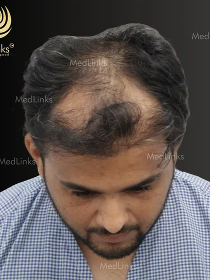 This patient was experiencing thinning across the top of his scalp. Our goal was to restore density and create a natural look. The 'before' image shows the extent of the hair loss, a common pattern we treat.