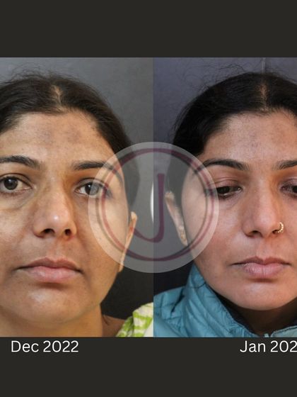 This image shows a one-month improvement in facial pigmentation during winter. By using specific medi-care and procedures, we were able to manage the hyperpigmentation that can often worsen in cold, dry weather, resulting in a clearer complexion.
