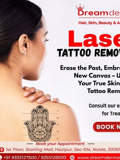 Ready for a new beginning? My laser tattoo removal service helps you erase unwanted ink and gives you a fresh canvas. It is a safe and effective way to reclaim your skin and embrace a new you.