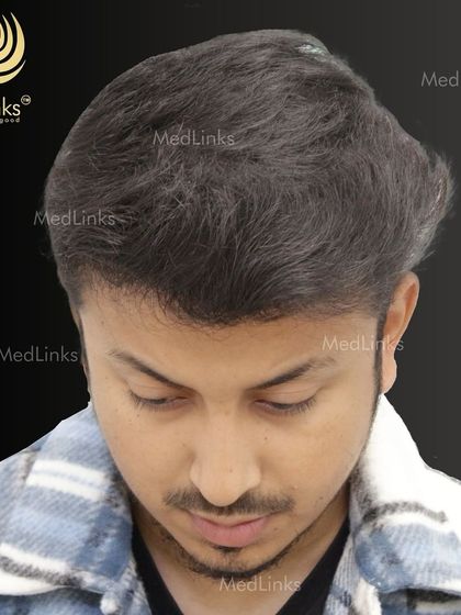 The top-down view after the transplant, showcasing the full coverage achieved.