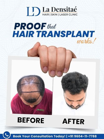Abhijeet never thought hair loss would bother him until it affected his confidence. With 4,137 grafts and the precision of the RT-FUE technique, I didn’t just restore his hairline, I restored the part of him he thought he had lost.