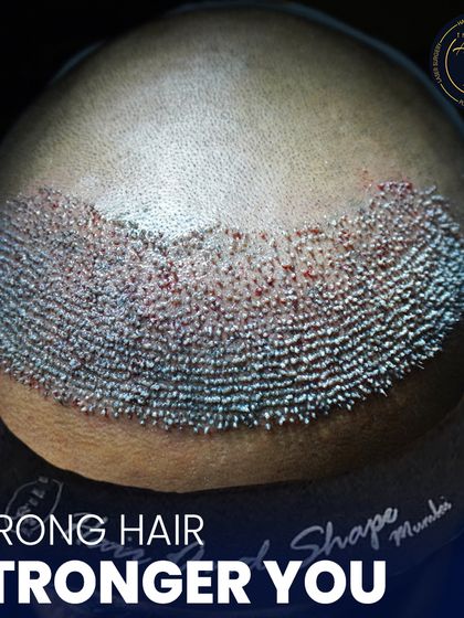 This is where science meets style. A detailed view of newly implanted hair follicles, showcasing the meticulous process of high-density hair restoration.