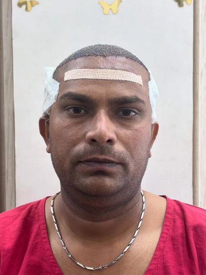 The patient right after the 5400 graft transplant, with the new hairline secured by a bandage.
