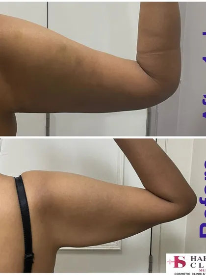 This is a one week post-procedure result for arm liposuction. The patient was concerned about "bat wings," and this treatment effectively removed the excess fat, creating a slimmer and more toned arm contour. This allows my patients to feel more confident in sleeveless clothing.