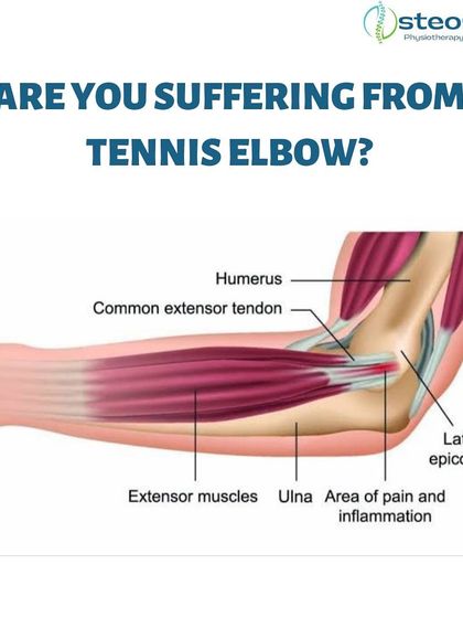 This anatomical illustration explains Tennis Elbow, a condition caused by overloaded tendons from repetitive wrist and arm motions. It's common not just in athletes but also in professions like plumbing and carpentry.