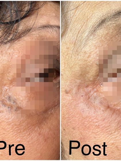 This image shows the before and after of treating senile comedones, which are large, open blackheads common in aging skin. A simple extraction procedure can clear these blemishes in one sitting, instantly improving the skin's appearance.
