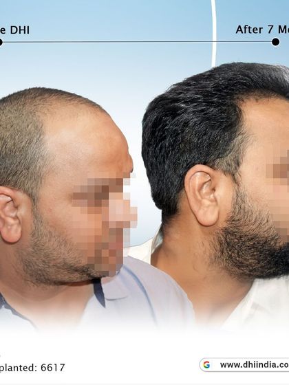 A side-profile view of the same client's 7-month progress. The restored hairline and increased thickness are clearly visible, showcasing a natural and youthful result.