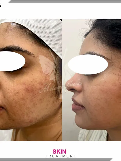 A side profile view showcasing the improvement in skin texture and reduction of acne-related marks.
