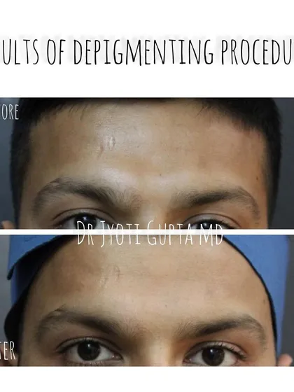 Even localized pigmentation can be effectively treated. This patient had a distinct patch of pigmentation on his forehead, which we successfully lightened with a single session of a depigmenting procedure combined with a skin hydration treatment.