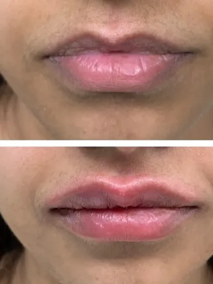 This before-and-after image shows the immediate, natural-looking result of a lip filler treatment. My approach focuses on restoring subtle volume and defining the lip shape to enhance your features, not alter them. The procedure is quick and provides a visible yet balanced enhancement.